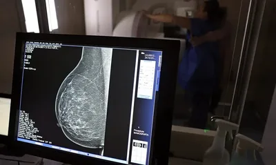 ANS amplia cobertura obrigatória de mamografia digital nos planos de saúde